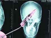 Bóng đá anh, ngoại hạng anh, lịch thi đấu euro 2012, Chữa bệnh hôi miệng lại phát hiện dao trong não