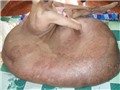 Sáng nay, bóc “chân voi” 90 kg cho anh Hải